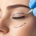 Eyelid Rejuvenation with Blepharoplasty in Islamabad