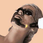 Best Laser Carbon Peel in Muscat