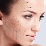 Thread Lift for Double Chin Reduction and Contouring