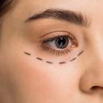 Eyelid Surgery Scars: Healing and Care Tips