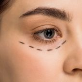 Eyelid Surgery in Oman