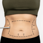 Laser Liposuction Results: When Will You See the Difference?