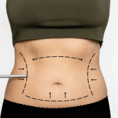 Laser Liposuction in Muscat