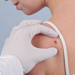 What Causes Lipomas and How Does Lipoma Treatment Help?