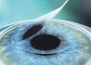 Lasik Surgery- Flap-Femtosecond
