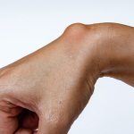 Do All Lipomas Need Lipoma Treatment?
