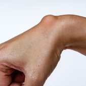 Lipoma Treatment in Muscat