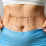What Is Liposuction Surgery and How Does It Work?