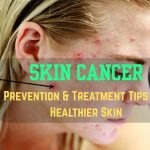 Skin Cancer Prevention & Treatment Tips for Healthier Skin