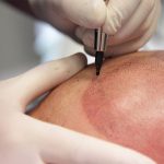 Scalp Micropigmentation Dubai: Choosing the Right SMP Clinic