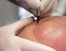 Scalp Micropigmentation Dubai