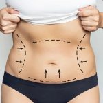 هل يمكن أن تساعد عملية شفط الدهون في تغيير شكل الجسم؟