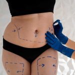ما هي المناطق التي يمكن علاجها بعملية شفط الدهون؟